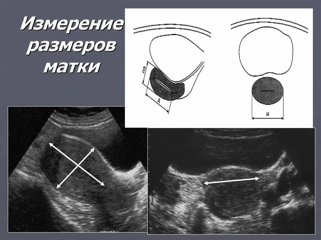 Полость матки 5. УЗИ матки измерения размеров. Размеры матки на УЗИ. Ширина матки УЗИ.