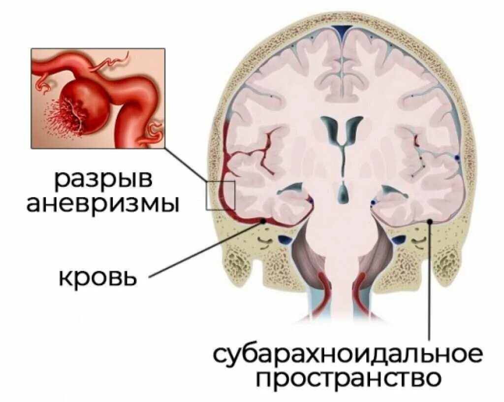 Субарахноидальные кровоизлияния симптомы. Субарахноидальное кровотечение на кт. Субарахноидальное гематома. Субарахноидальное кровоизлияние инсульт кт.