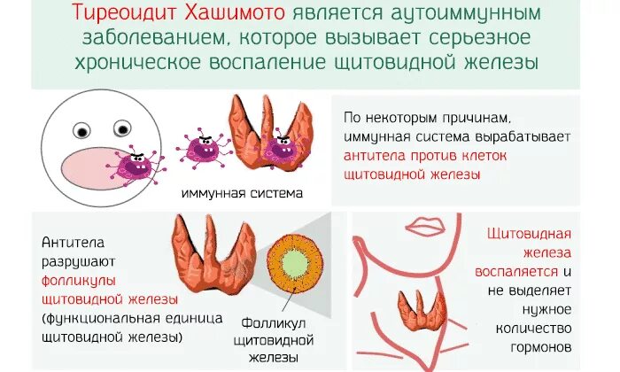 Аутоиммунныйтмреоидит. Хронический аутоиммунный тиреоидит синдромы. Аутоиммунныйтмреоидит. Аутоиммунныйтмреоидит. Аутоиммунный тиреоидит эпидемиология.