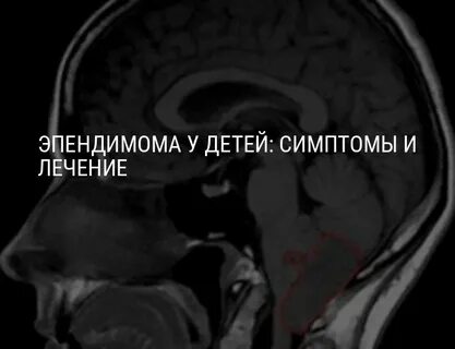 Анапластическая эпендимома