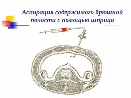Экг брюшной полости