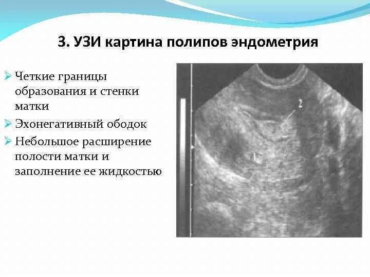 Полип эндометрия в матке причины. Узи картина полипа эндометрия. эхограммы полип эндометрия. полипоз эндометрия на узи. полип эндометрия на узи описание.