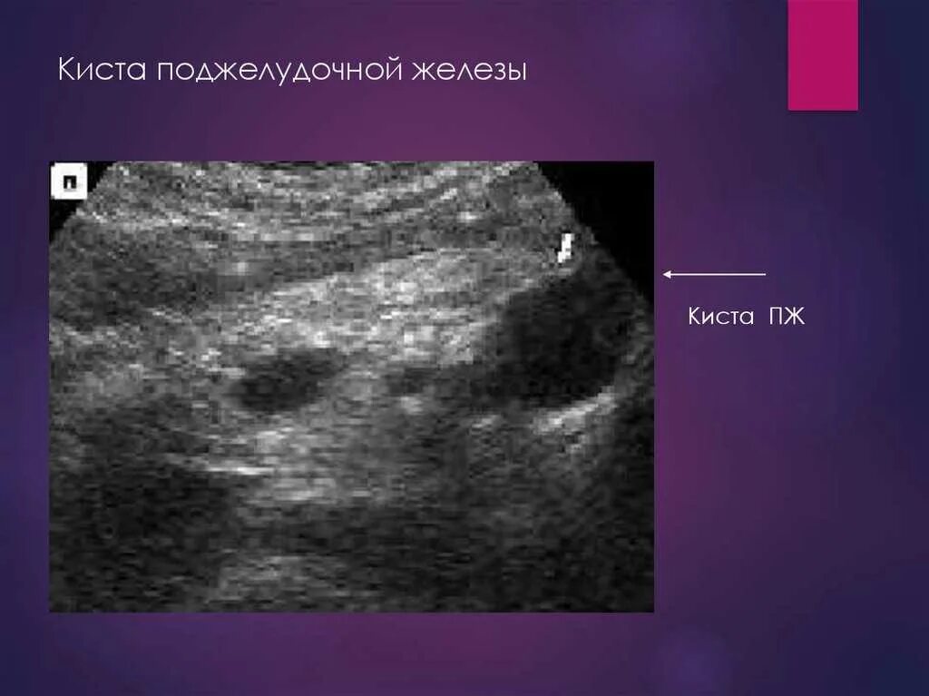 Лечение диффузно кистозной. Липоматоз поджелудочной железы на УЗИ. Малигнизация кисты поджелудочной железы. Киста псевдокиста поджелудочная железа УЗИ. Кальцинат поджелудочной железы.