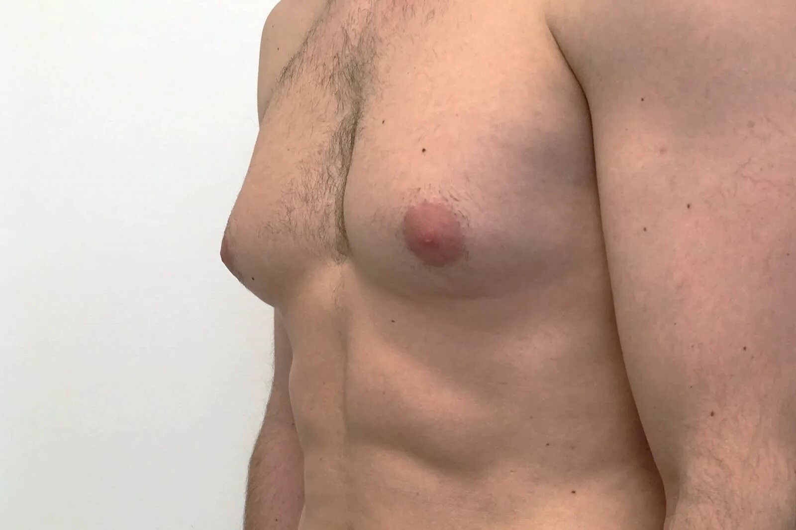 Гинекомастия пролиферирующая. Гипертрофированная гинекомастия. Male breast. Мужская грудь. Male breast.