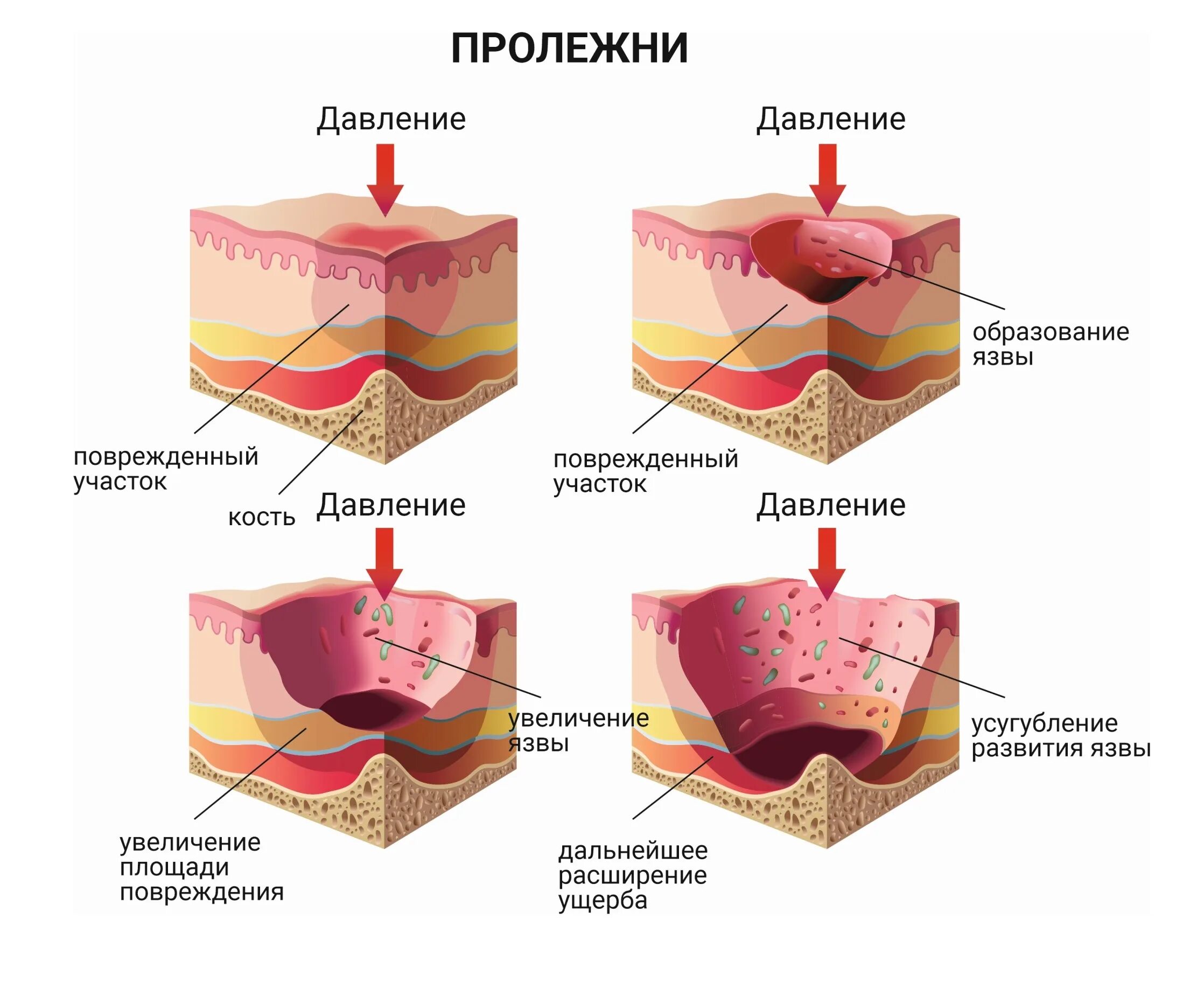 Как вылечить пролежни. Как вылечить пролежни