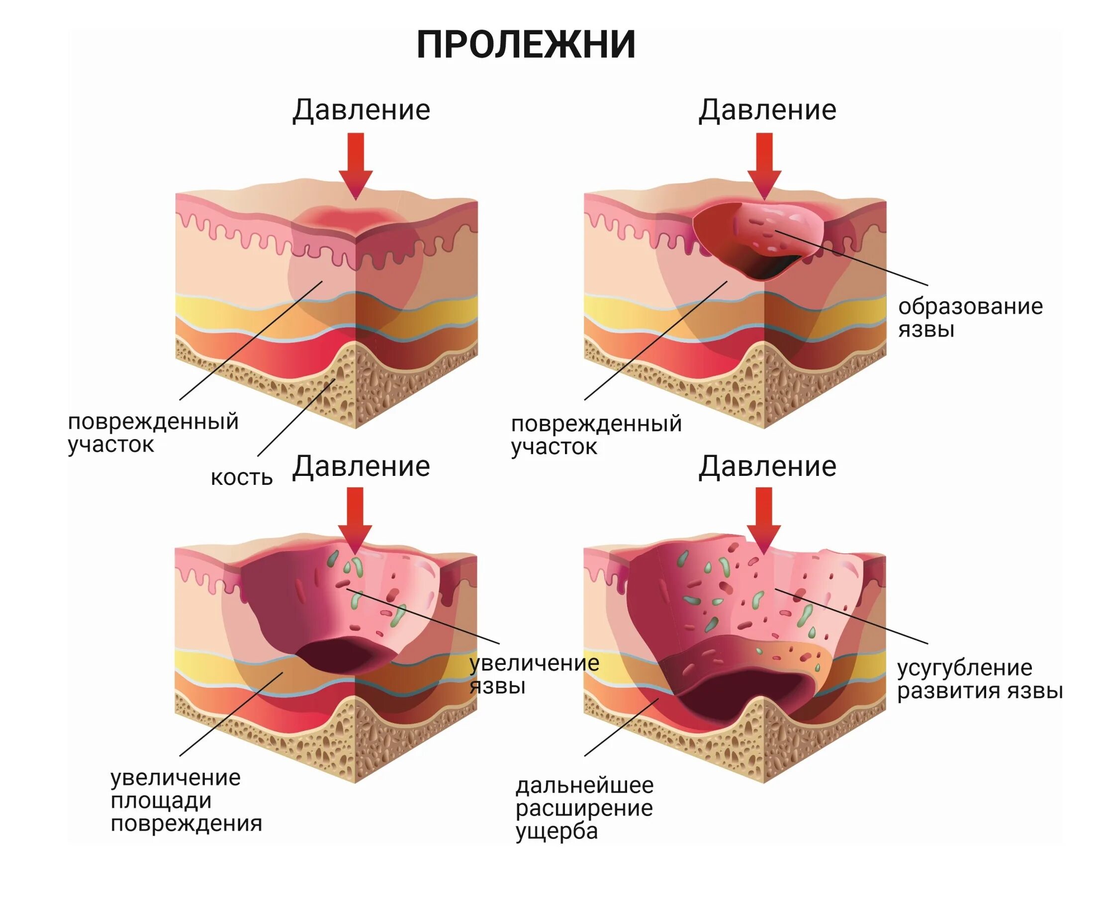 Пролежни у больного