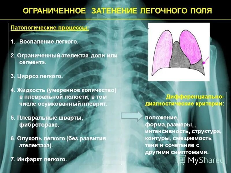 Фиброз нижних долей легких. Ателектаз доли легкого. Ограниченное затенение легочного поля. Сегментарный ателектаз легкого.