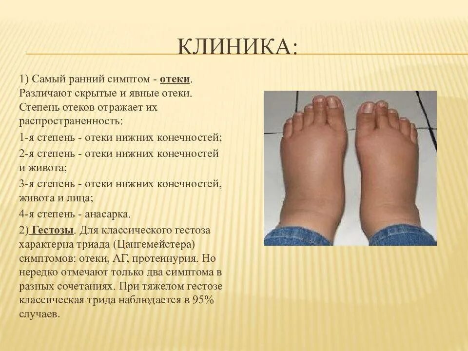 Как понять что есть отеки. Отеки нижних конечностей. признаки проявления скрытых отеков.