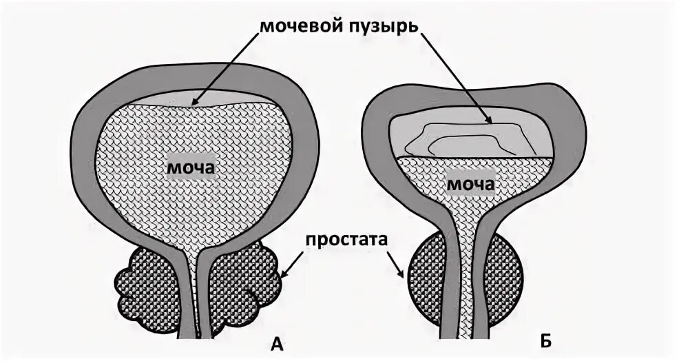 Частое мочеиспускание после тур. Рисунок аденомы простаты и мочевого пузыря. Мочевой пузырь продольный разрез. Мочеиспускание при аденоме простаты.