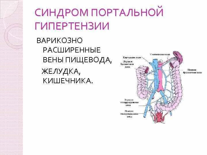 Варикозно расширенные вены пищевода. Вены пищевода портальная гипертензия. Синдром портальной гипертензии. Правая желудочная вена