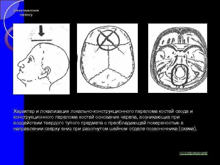 Для перелома основания черепа характерно. Перелом основания свода черепа схема. Перелом костей основания черепа. Перелом костей свода черепа. Перелом костей свода и основания черепа.