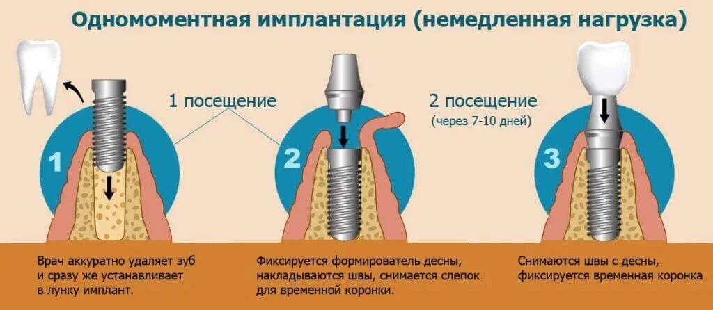Можно ли поставить зуб после удаления. Одноэтапная методика имплантации. двухэтапная методика имплантации зубов. этапы установления имплантата зуба. одномоментная имплантация зубов этапы.
