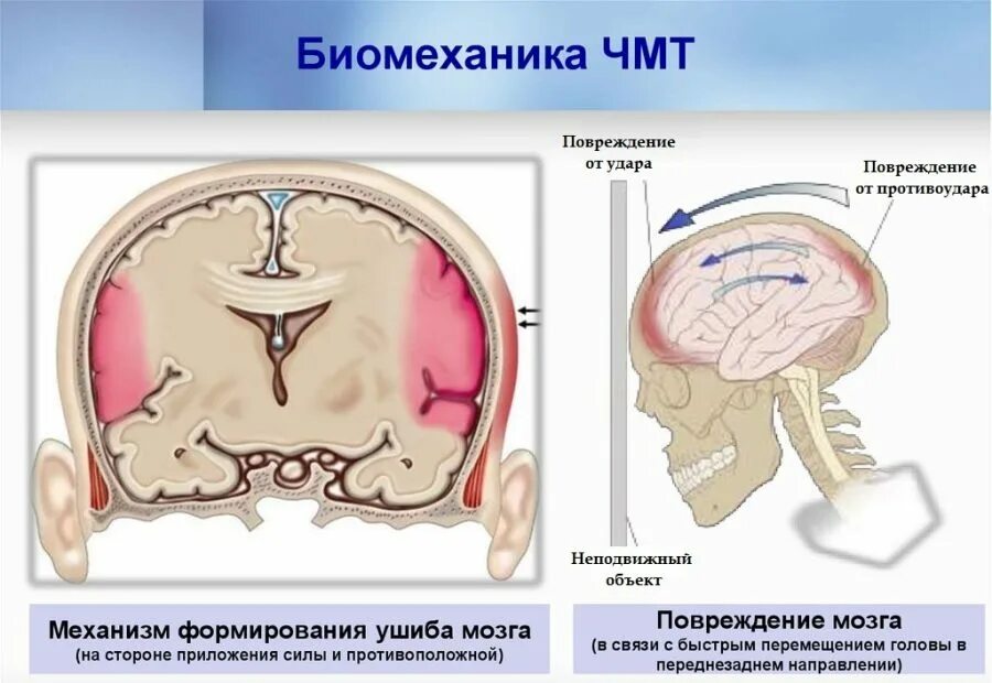 Повреждения головного мозга возникают. Ушиб головного мозга механизм возникновения. ЧМТ ушиб головного мозга. Механизмы повреждения мозга. Закрытая травма головы.