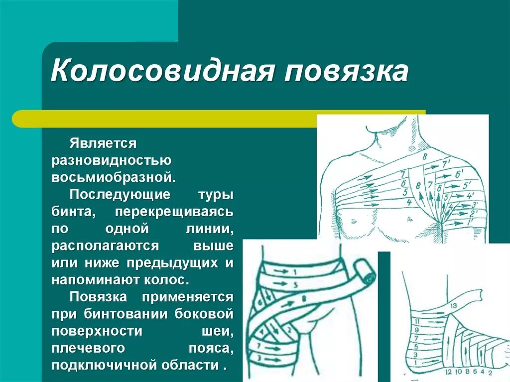 Плечевая повязка алгоритм. Колосовидная повязка техника. Колосовидная бинтовая повязка. Техника наложения колосовидной повязки. Колосовидная повязка показания.