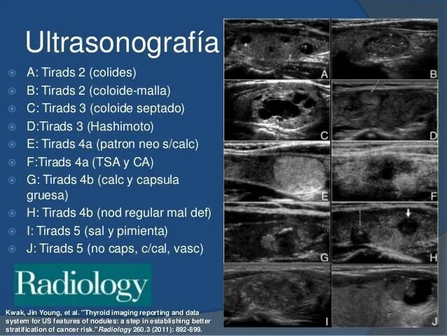 Eu tirads. Тирадс 5 щитовидной железы УЗИ. Tirads классификация узлов щитовидной железы УЗИ. Что такое Tirads 3 на УЗИ щитовидной железы. Tirads классификация в УЗИ.