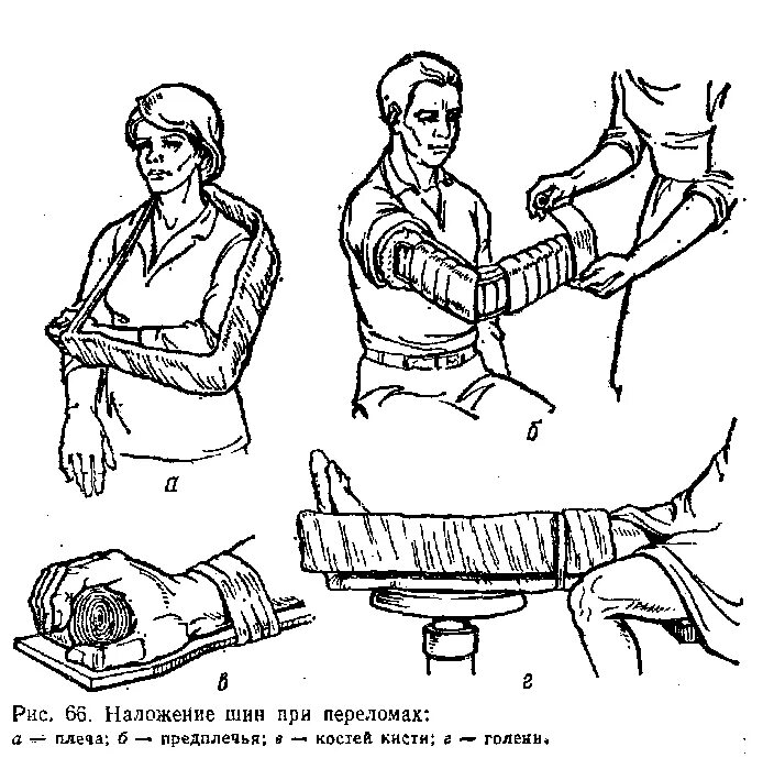 При открытом переломе перед наложением шины. Перелом костей предплечья ПМП. Иммобилизация перелома предплечья алгоритм. Перелом локтевого отростка иммобилизация. Шинирование при переломах конечностей.