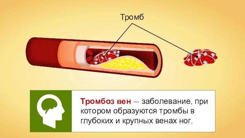 Кровотечения 8 класс биология. Сердечно-сосудистые заболевания первая помощь при кровотечении. Заболевания при которых образуются тромбы. Формирование тромба биология.