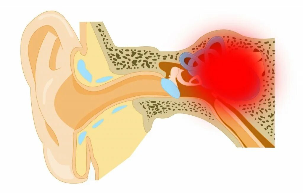 Менингогенный лабиринтит. Травматический лабиринтит. Внутренний отит (лабиринтит). Тимпаногенный лабиринтит. Внутреннее ухо лечение и симптомы
