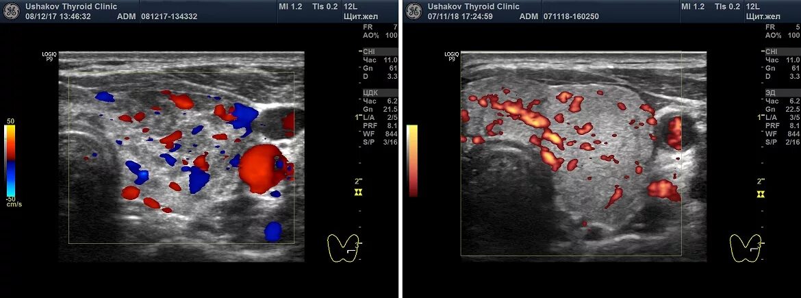 Усиленная васкуляризация. УЗИ щитовидной железы и цветовое допплеровское картирование. УЗИ молочных желез цветовое допплеровское картирование. Цветовое допплеровское картирование кровотока. Цветное доплеровское картирование щитовидной железы.