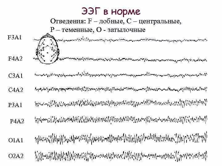 Ээг ребенку какую делать. Расшифровка показателей электроэнцефалограммы ээг головного мозга. норма ээг у ребенка 4 лет норма.