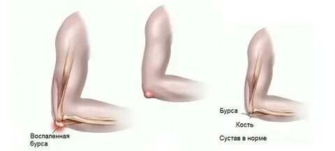 Бурсит локтевого сустава код по мкб 10