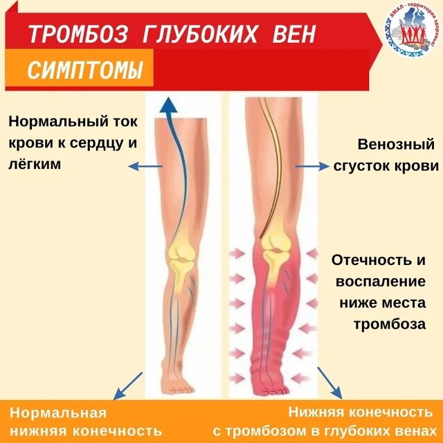 Где отрывается тромб у человека. Острый тромбоз глубоких вен нижних конечностей.