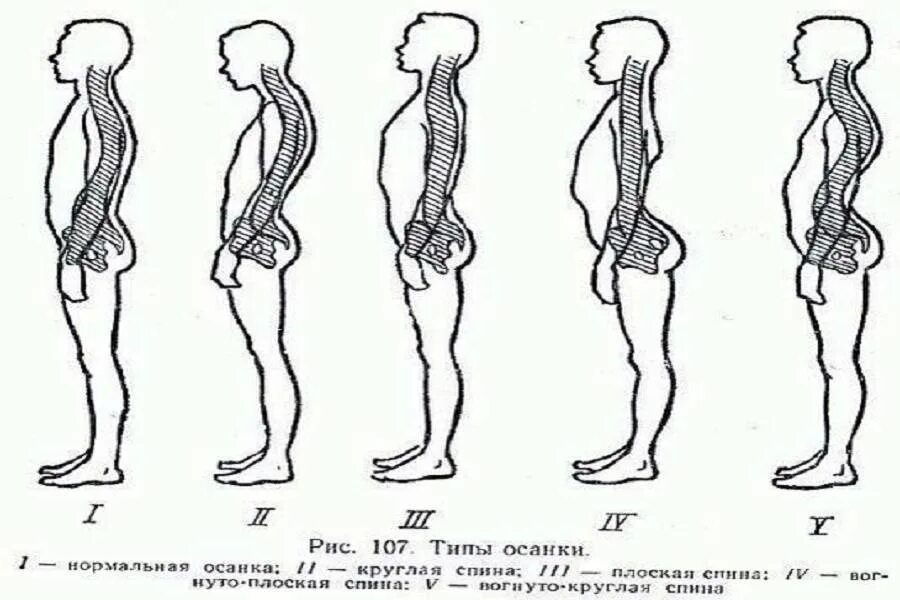 Нарушение осанки кифоз сколиоз. Искривление позвоночника лордоз кифоз сколиоз. Лордоз кифоз сколиоз у детей. Нарушение осанки лордоз кифоз сколиоз.