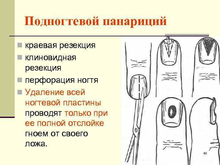 Краевая резекция пластины