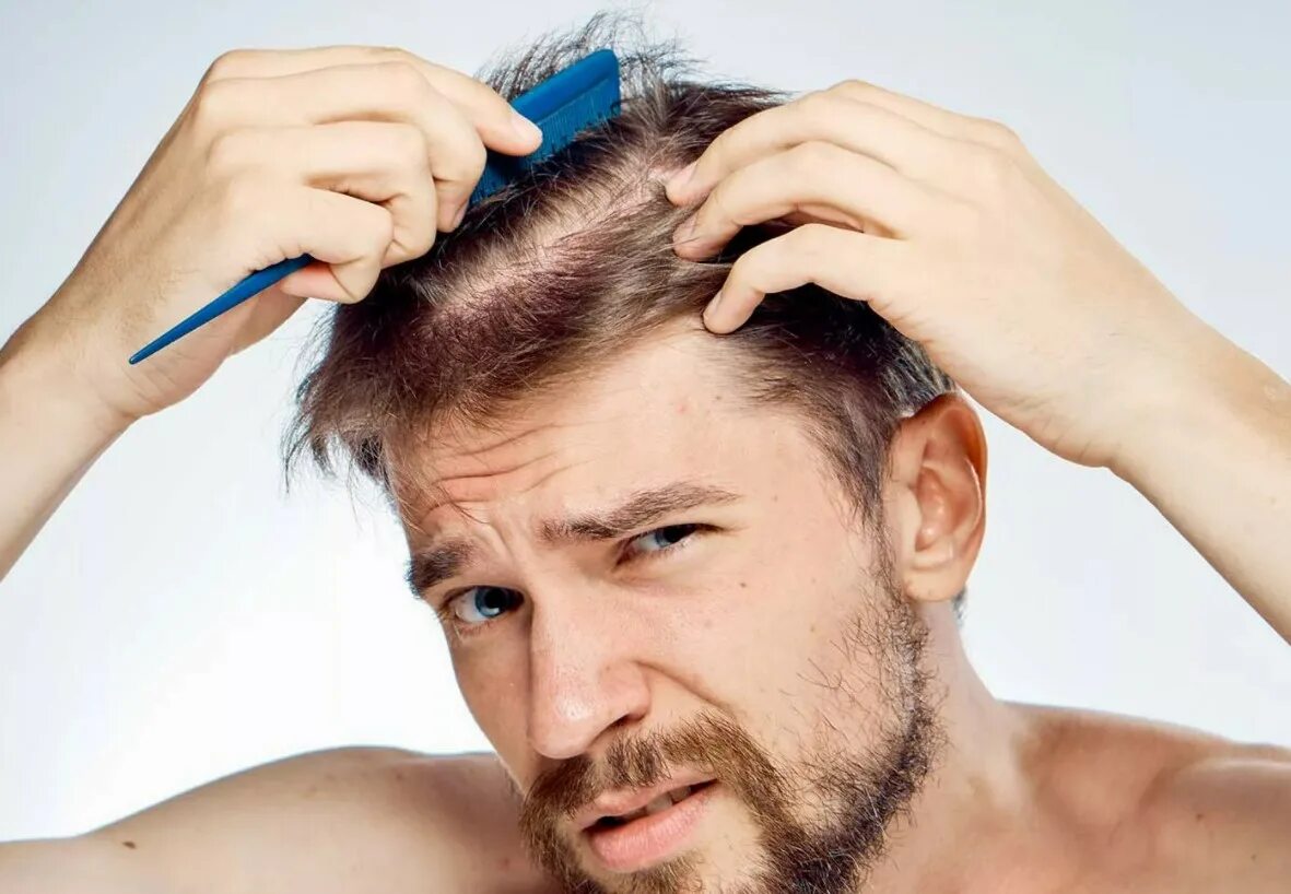 Выпадение волос у мужчин лечение. Поредение волос у мужчин.