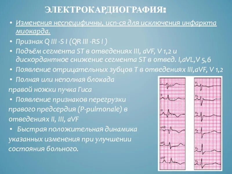 Изменение зубца q. Зубец q II-III, AVF, подъем St.. Острое легочное сердце на ЭКГ. Подъем St v1 на ЭКГ. Подъем St на ЭКГ v1-v2.