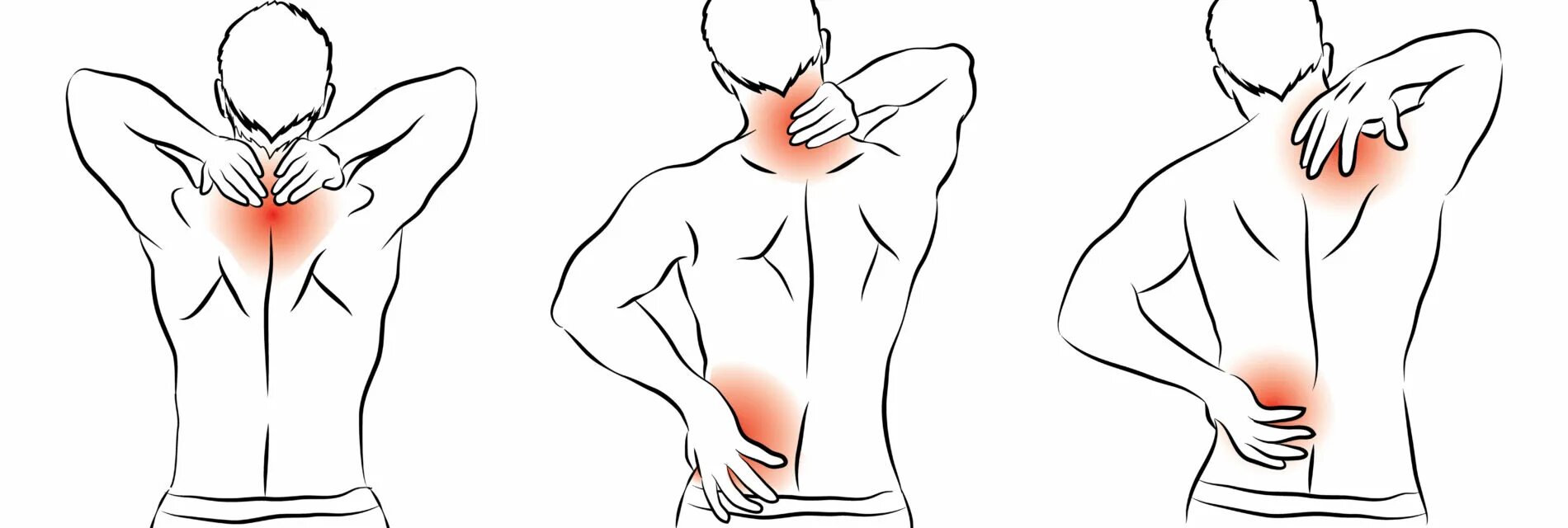 Поясница отдает в колено. Межреберная невралгия упражнения. Иррадиация боли в пояснице. Невралгические боли в спине.