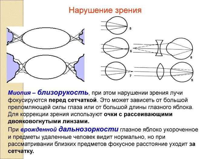 Волнообразное изображение искажение зрения. Зрительный анализатор строение и функции близорукость. зрительный анализатор миопия. зрительный анализатор нарушение зрения. нарушение зрения близорукость.