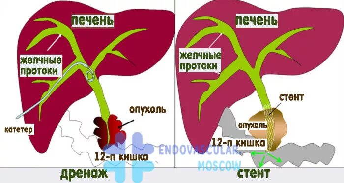 Стенты желчного протока. Стенд в желчный проток. Стент общего желчного протока. Стент желчного протока