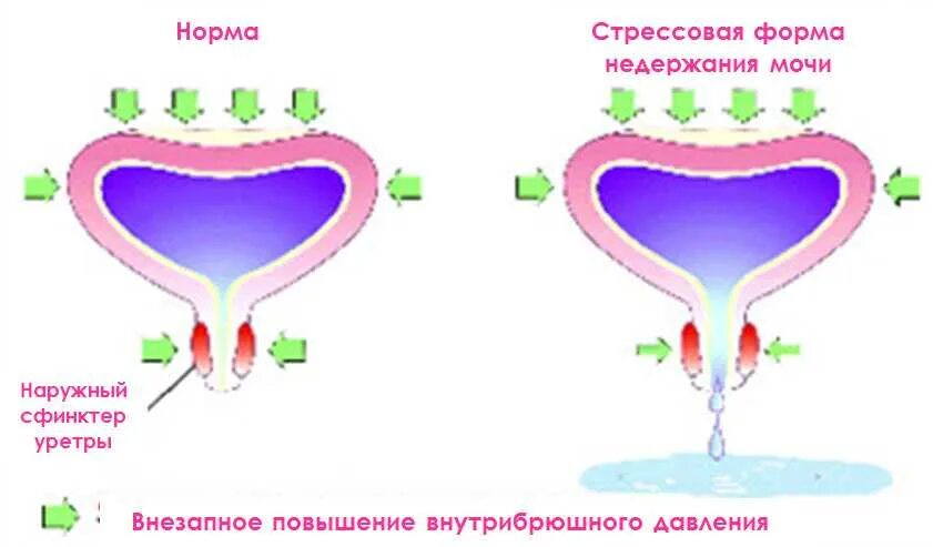 Операция стрессовое недержание мочи. Недержание мочи. Недержание мочи у женщин. Стрессовое недержание мочи. Капельное недержание мочи.