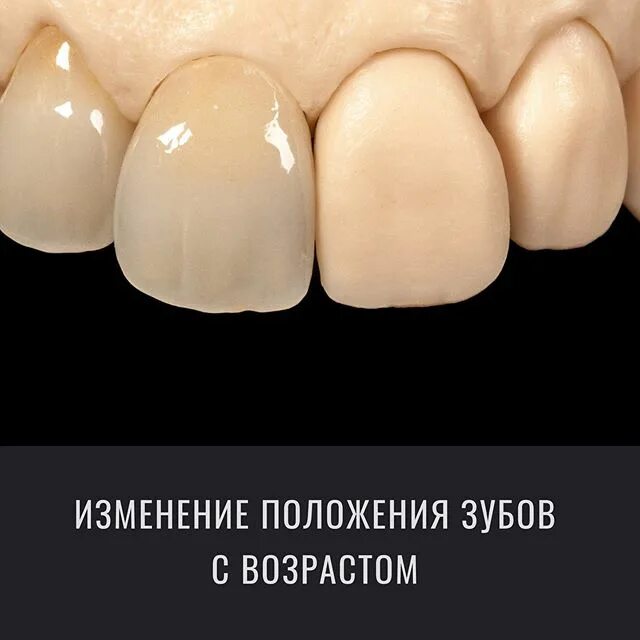 Металлокерамика (керамика noritake). Безметалловая керамика emax. Резцы металлокерамика. Металлокерамика резцы. Резцы металлокерамика.