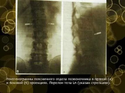 Клиновидная деформация тел позвонков