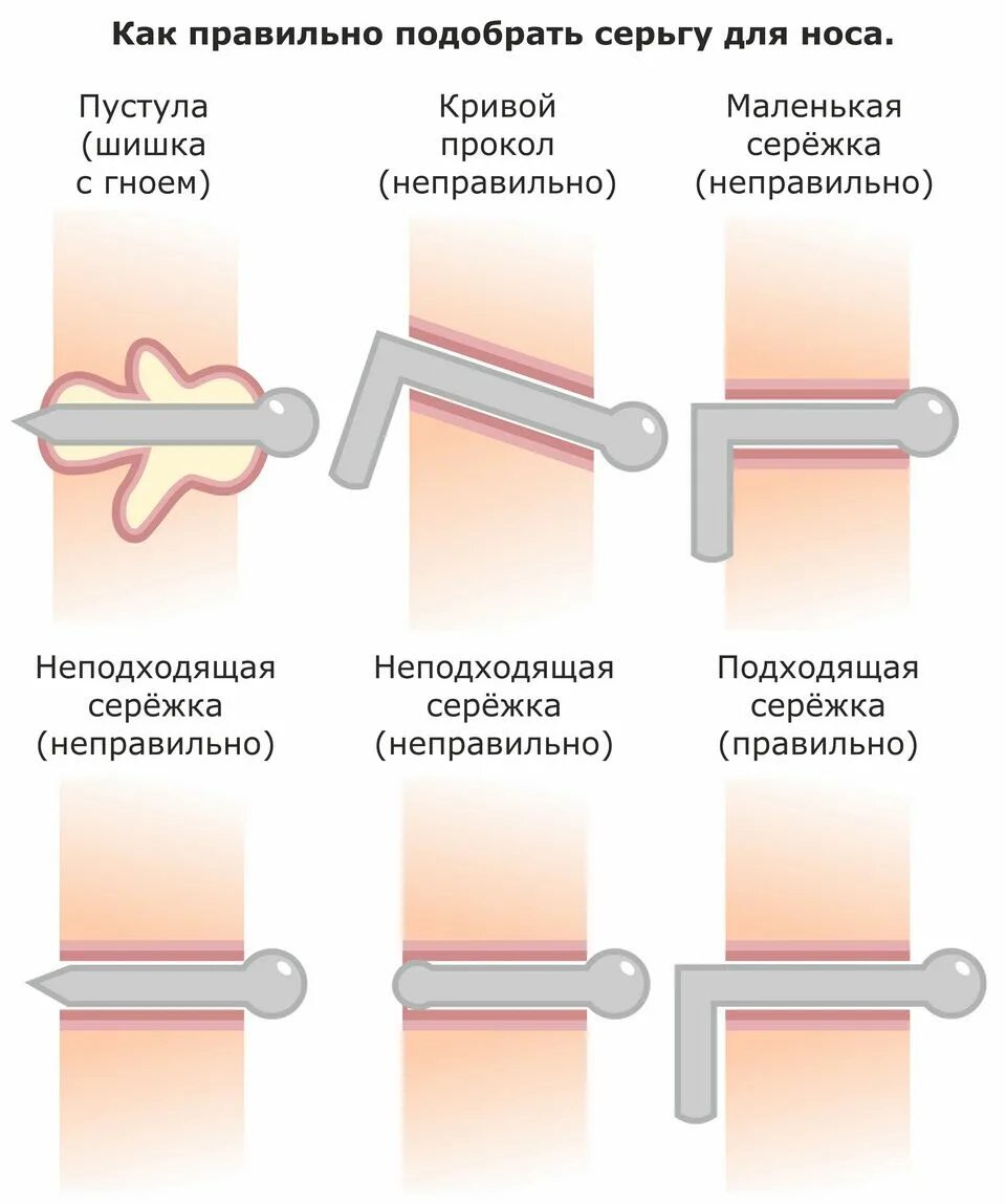 Сколько нужно обрабатывать прокол. Шишка около прокола носа. гранулема прокола крыла носа.