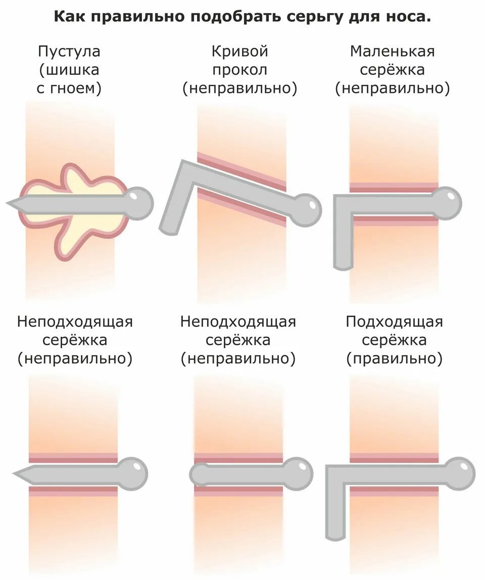 Сколько нужно обрабатывать после прокола. Шишка около прокола носа. Гранулема возле прокола. Гранулема после прокола носа. Гранулема на проколе крыла носа.