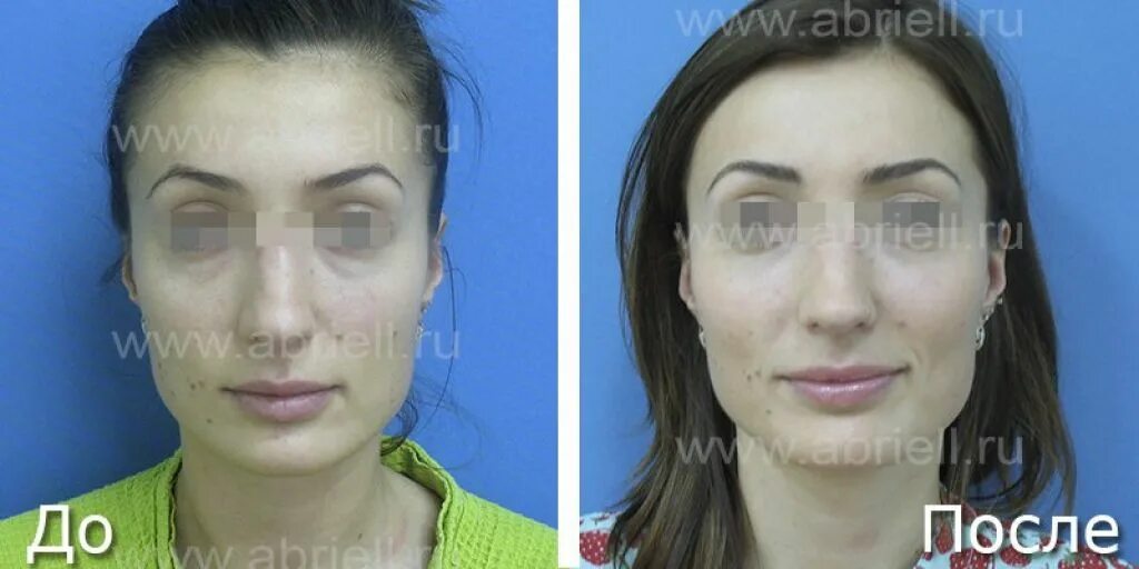 Липофилинг грудных желез lipofiling grudi
