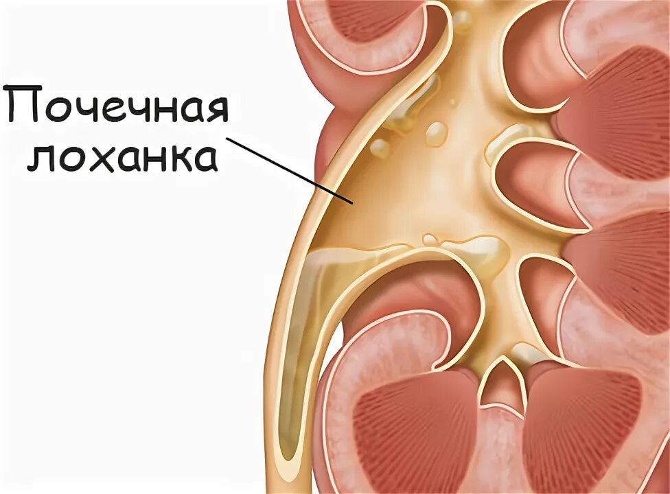 Расширинная лоханка почки у ребёнка. Расширение лоханки почки пиелоэктазия. Расширенная лоханка. Расширенная лоханка у ребенка.