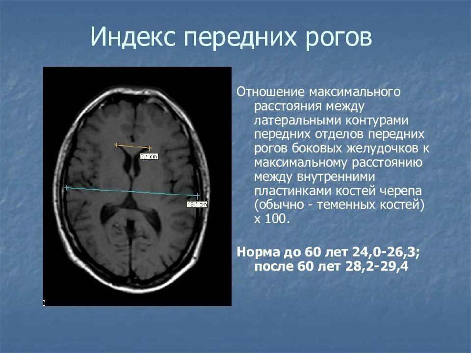 Ширина желудочков головного мозга на кт. Боковые желудочки головного мозга на мрт. Желудочки мозга норма кт. Индекс 3 желудочка головного мозга. Расширение боковых рогов