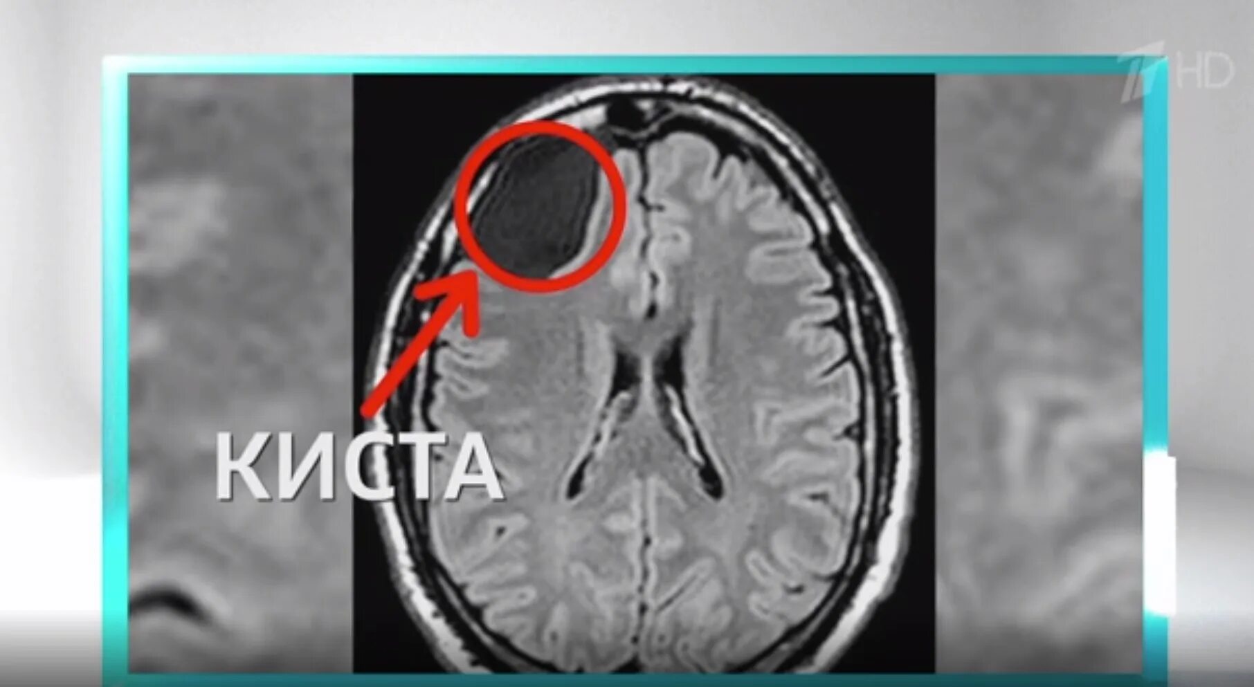 Киста в мозгах последствия. Киста в головном мозге у ребенка. Эпидермальная киста головного мозга на мрт. Киста ГМ на мрт ребенка. Киста головного мозга у новорожденного.