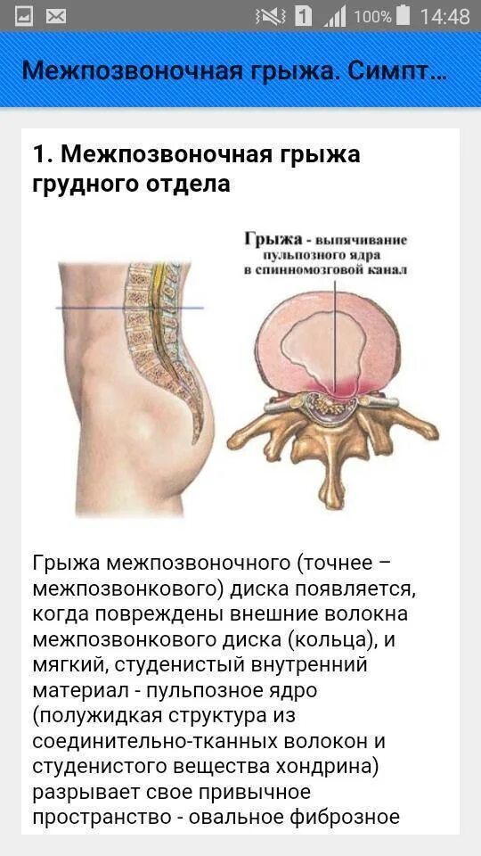 Как понять что грыжа в пояснице. Вентральная межпозвоночная грыжа. межпозвоночная грыжа симптомы. синдромы спинной грыжи. грыжа поясничного отдела симптомы.