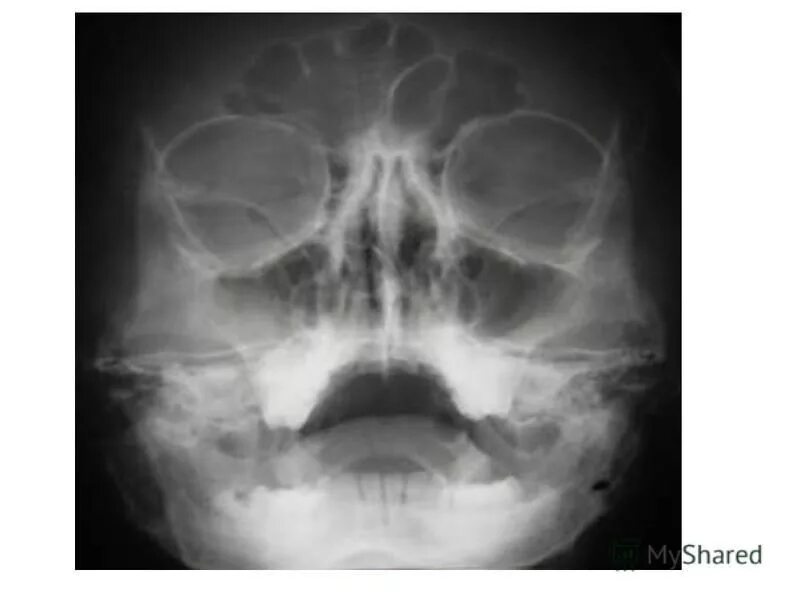 кисты верхнечелюстных пазух головного мозга