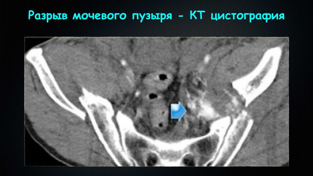 Внутрибрюшинный разрыв мочевого пузыря рентген. Внебрюшинный разрыв мочевого пузыря кт. Разрыв мочевого пузыря на кт. Травмы мочевого пузыря кт.