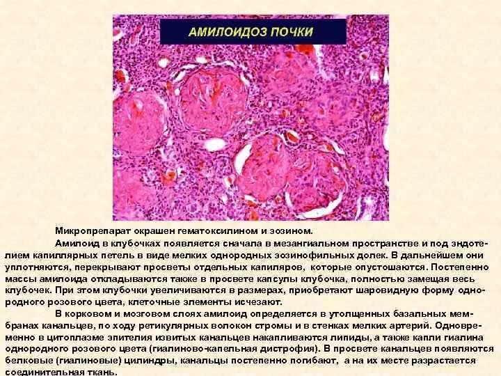 Саговая селезенка. Амилоидоз почки микропрепарат описание. Амилоидоз препарат патанатомия. Микропрепарат амилоидоз почки окраска Конго-красным. Амилоидоз почки описание макропрепарата.