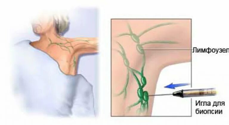 Лимфоузлы под мышками расположение у женщин. Тонкоигольная биопсия лимфоузлов. Пункционная биопсия лимфатического узла. Тонкоигольная аспирационная биопсия лимфоузлов. Эксцизионная биопсия лимфоузла.