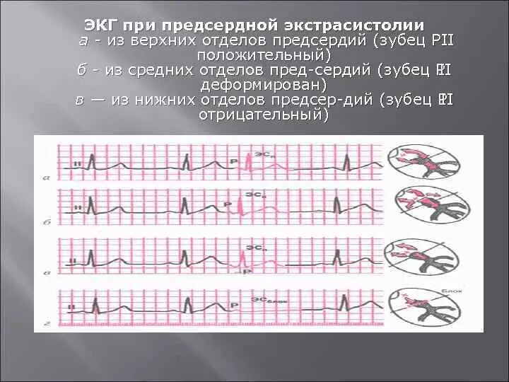 Предсердная экстрасистолия на ЭКГ. Экстрасистола предсердия на ЭКГ. Предсердные экстрасистолы на ЭКГ. ЭКГ при предсердной экстрасистоле. Блокированные экстрасистолы