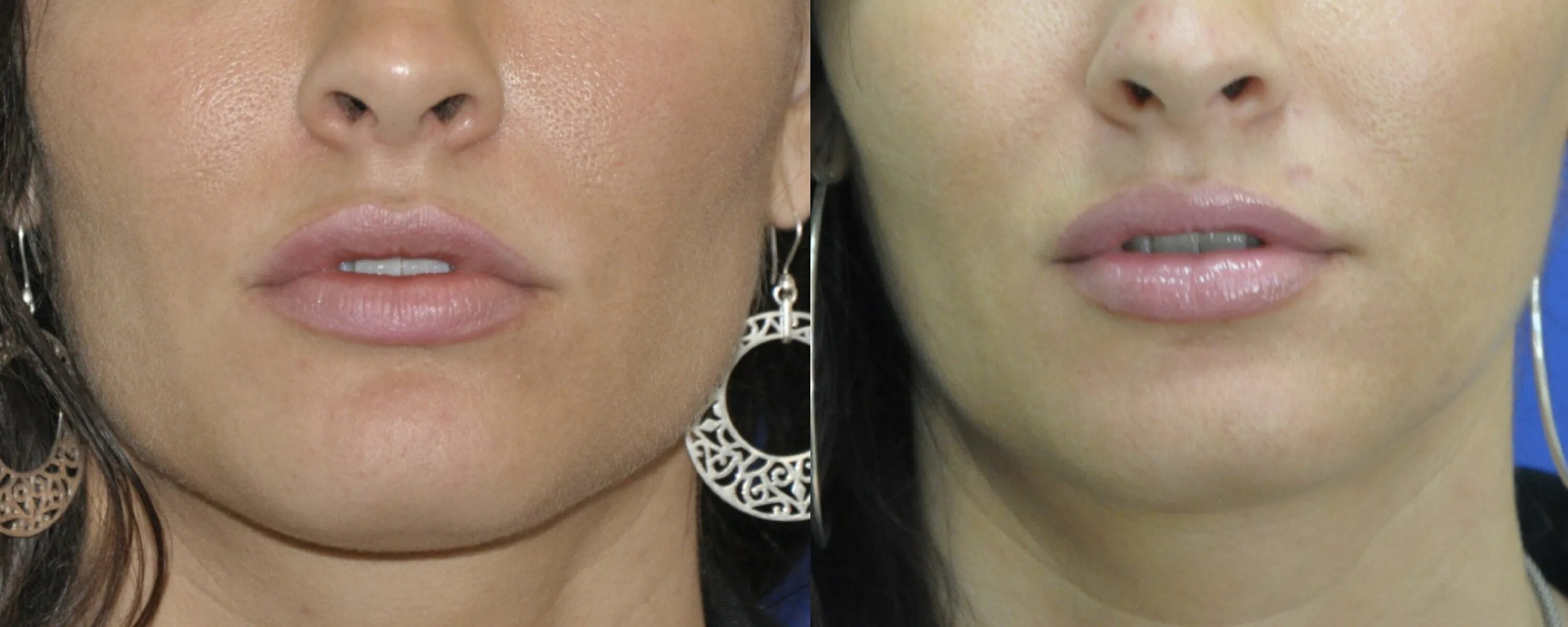 Ботокс подбородка до и после фото Say goodbye to the double chin! Join JoAnn Francis Medical Esthetics tomorrow. D