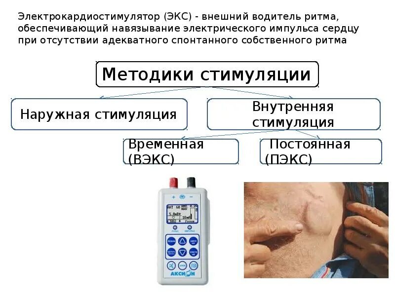 Кардиостимулятор при каком пульсе. Наружный кардиостимулятор. электрокардиостимулятор внешний. кардиостимулятор прибор. постоянная электрокардиостимуляция.